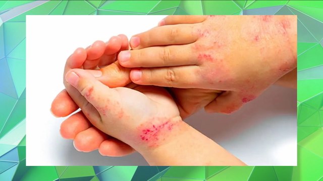 Los niños y las enfermedades dermatológicas más frecuentes