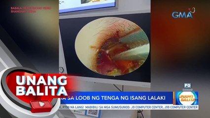 Ipis, nakita sa loob ng tenga ng isang lalaki | UB