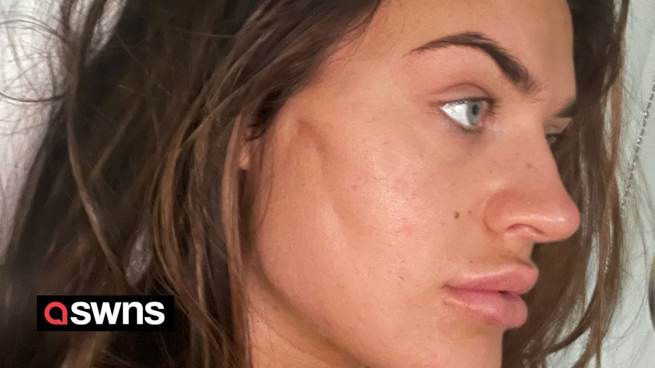 "Botched 'thread lift' left me looking like a Halloween character"