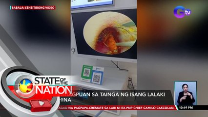 Ipis, natagpuan sa tainga ng isang lalaki sa China | SONA