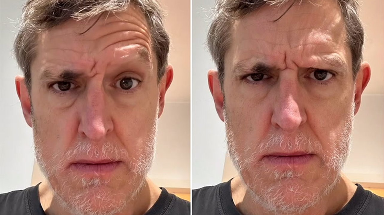 Louis Theroux shares alopecia health update as he asks fans for advice