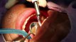 Dental Implants Richmond - Best Smiles - Dental Care