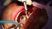 Dental Implants Richmond - Best Smiles - Dental Care
