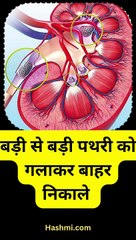 बड़ी से बड़ी पथरी को गलाकर बाहर निकालने के लिए आजमाएं ये 5 असरदार उपाय #shorts