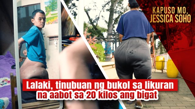 Lalaki, tinubuan ng bukol sa likuran na aabot sa 20 kilos ang bigat | Kapuso Mo Jessica Soho