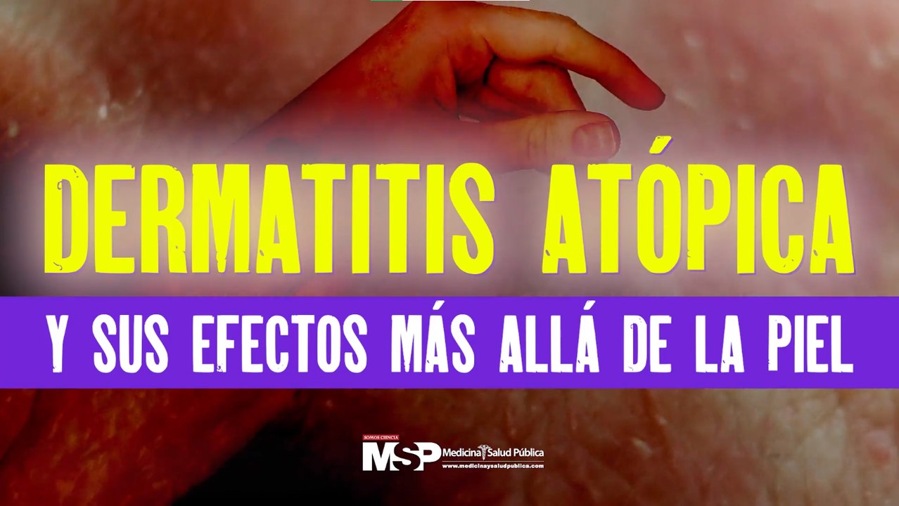 Mejores momentos de “Dermatitis atópica y sus efectos más allá de la piel” - #ExclusivoMSP