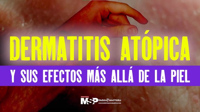 Mejores momentos de “Dermatitis atópica y sus efectos más allá de la piel” - #ExclusivoMSP