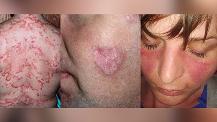 bd-viviendo-con-lupus-la-enfermedad-de-las-mil-caras-071223