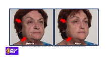 Shrink Under-Eye Bags and Wrinkles with Plexaderm’s 10 Minute Challenge
