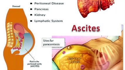 Detect Liver Cirrhosis Before It's Too Late!