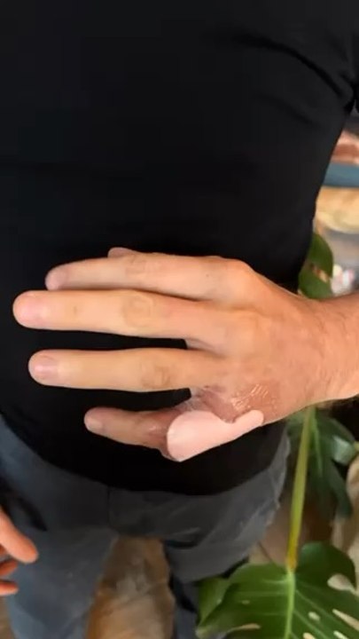 La réeducation est en cours ! Beaucoup de travail mais les progrés sont au rendez-vous  J’ai hâte de pouvoir remettre les mains dans la terre ‍