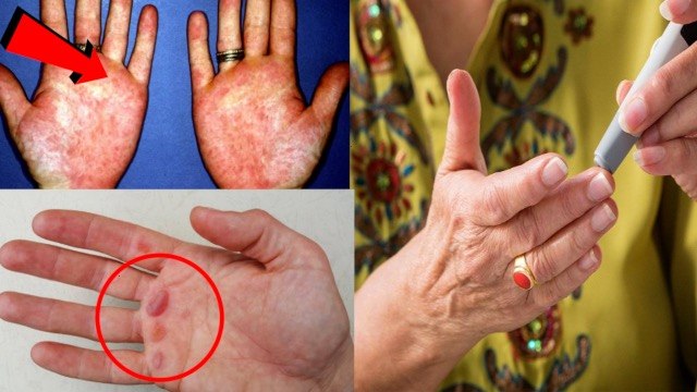 Diabetes Early Signs: Hand Symptoms में High Blood Sugar Indicate Video | Boldsky