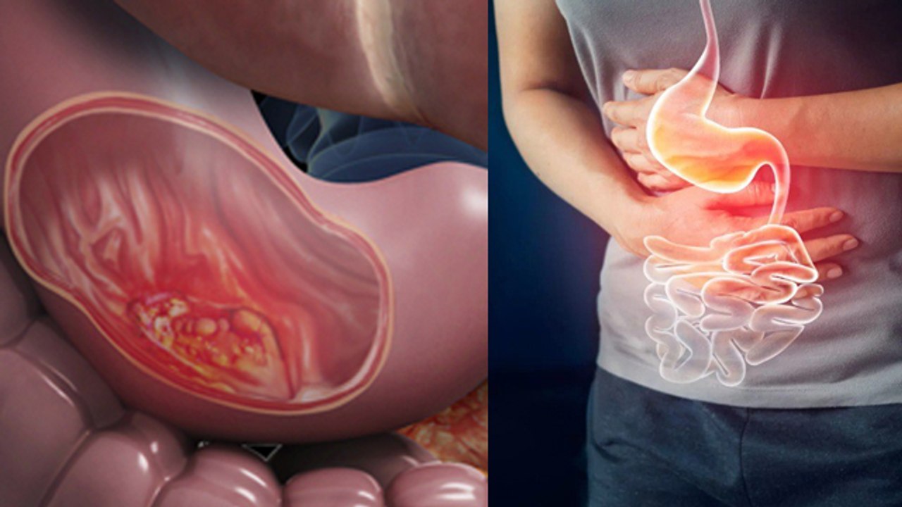 India में Stomach Cancer Increase Reason, Causes & Treatment In Hindi | Boldsky