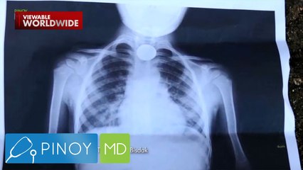 4-anyos na bata, nakalunok ng limang pisong barya! | Pinoy MD