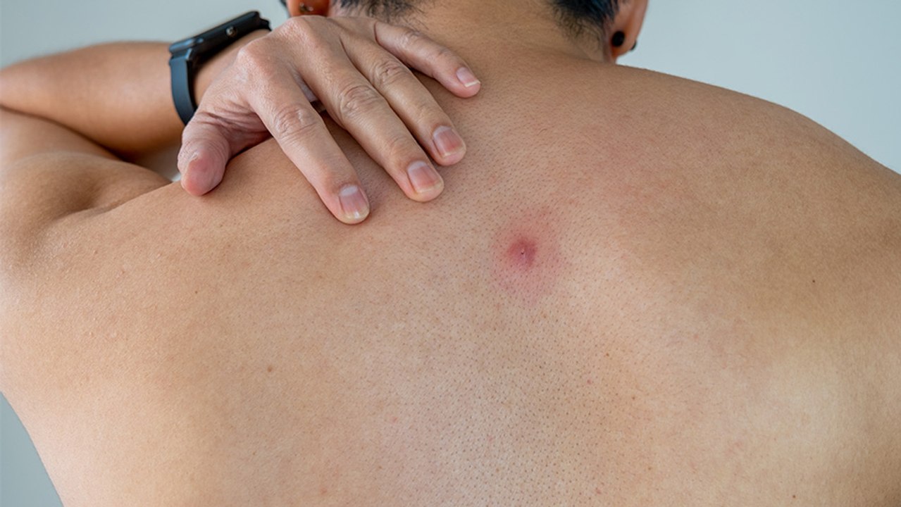 bd-complicaciones-de-abscesos-y-tratamiento-adecuado-121223