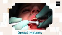 Dental Implants in Richmond, TX: Restoring Your Perfect Smile | Inspire Smile - Richmond Dentist