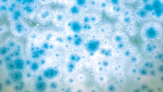 Woman's flu symptoms turns out to be flesh-eating bacteria ravaging her body