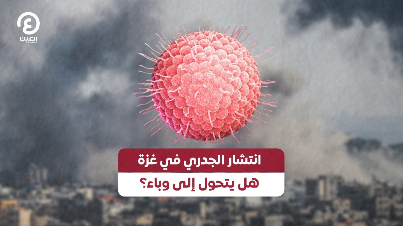 انتشار الجدري في غزة.. هل يتحول إلى وباء؟