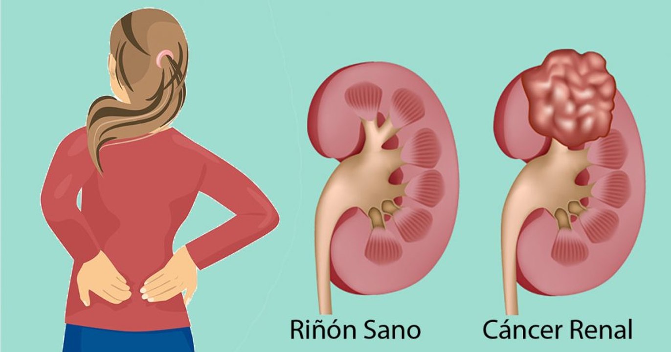 Hablemos de cáncer en el riñón