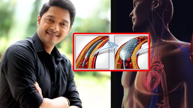 Angioplasty Surgery Kya Hai|Angioplasty Surgery Kaise Hota Hai|Angioplasty Surgery Kab Karna Chahiye