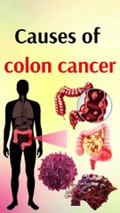 Causes of colon cancer