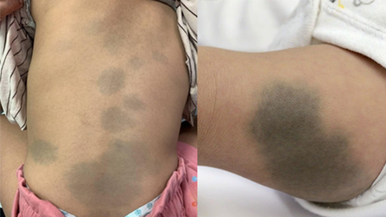 Newborn Baby Body Black Blue Spots Reason, Pediatric Metabolic Disorder ...