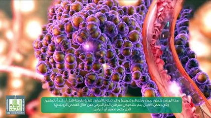 سرطان الدم المزمن