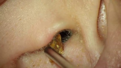 TOTAL OBSTRUCTION EAR WAX REMOVAL HD