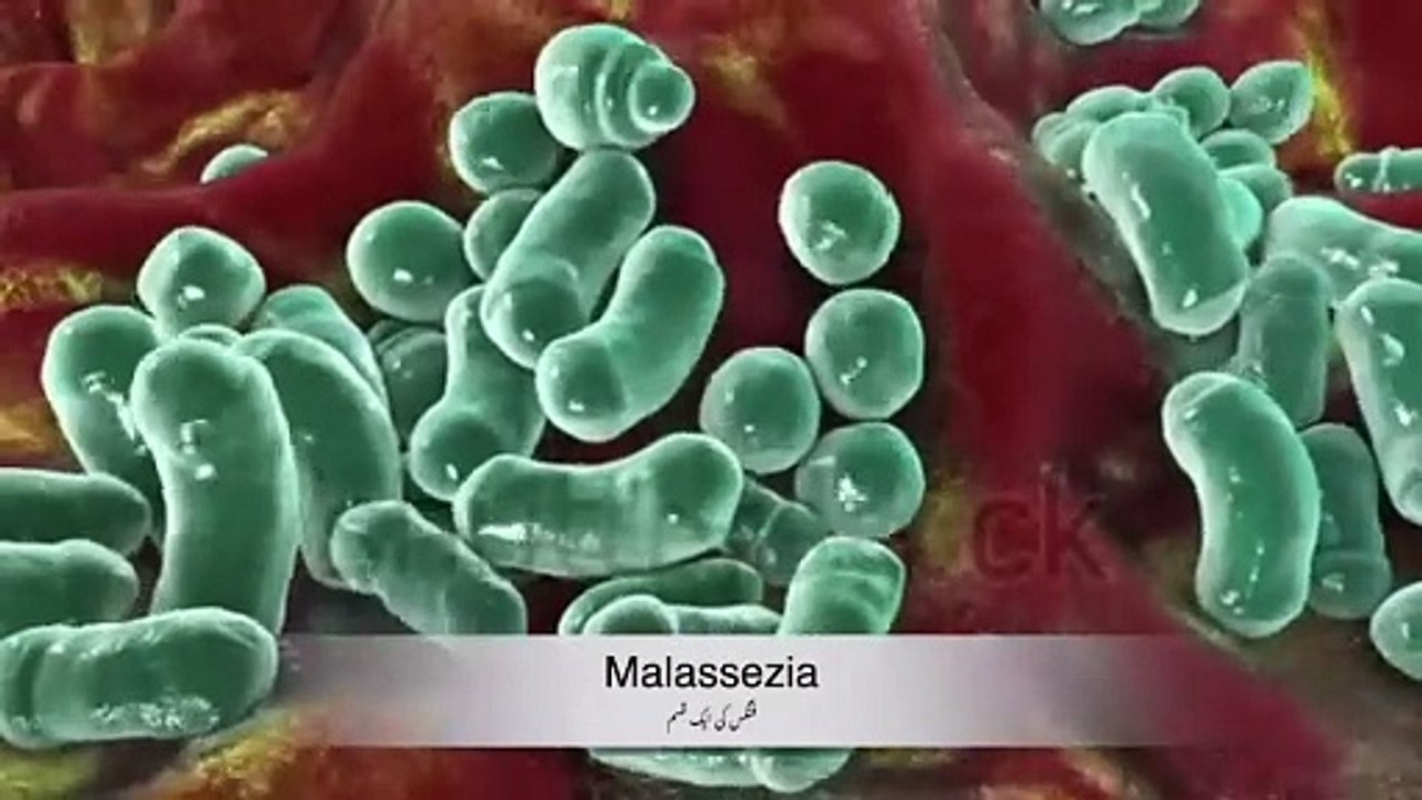 The REAL Cause and Cure for DANDRUFF I शुष्कता