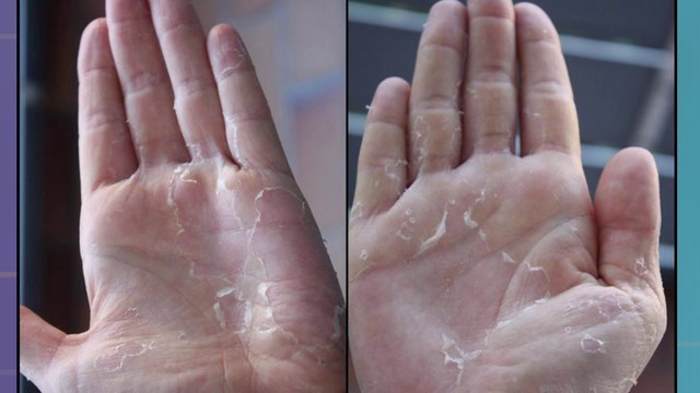 bd-causas-y-tratamientos-de-piel-seca-211223