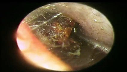 BIGGEST Earwax Removal by Doctor Anh