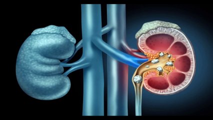 وصفات طبيعية لعلاج حصوات الكلى