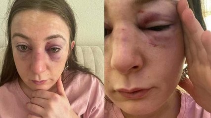 Yüzünü tanınmayacak hale getirdi! Her kafa darbesine 1 yıl