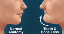 بعد فقدان الأسنان. الوصايا العشر للحفاظ على عظام الفك من التآكل و اللثة من الضمور و تغير شكل الوجه