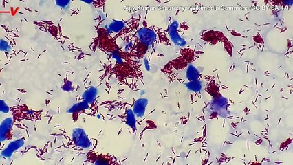 Leprosy Cases on the Rise in the US and Doctors Don’t Know Why