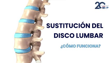 ¿Cómo y para qué se realiza una sustitución del disco lumbar? - #ExclusivoMSP