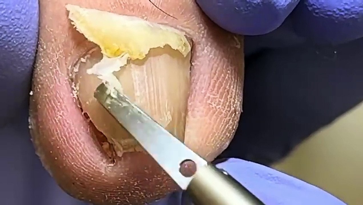 What a big nail The nails are crazily embedded in the root of the nail【Doctor Liu Pedicure】