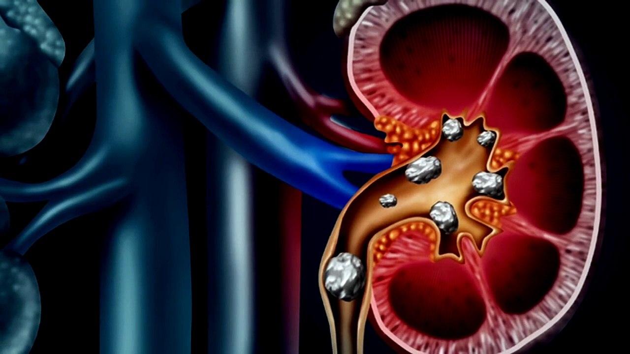 Eliminate Kidney Stones With Lemons – Kidney Stone Causes & Lemon Benefits