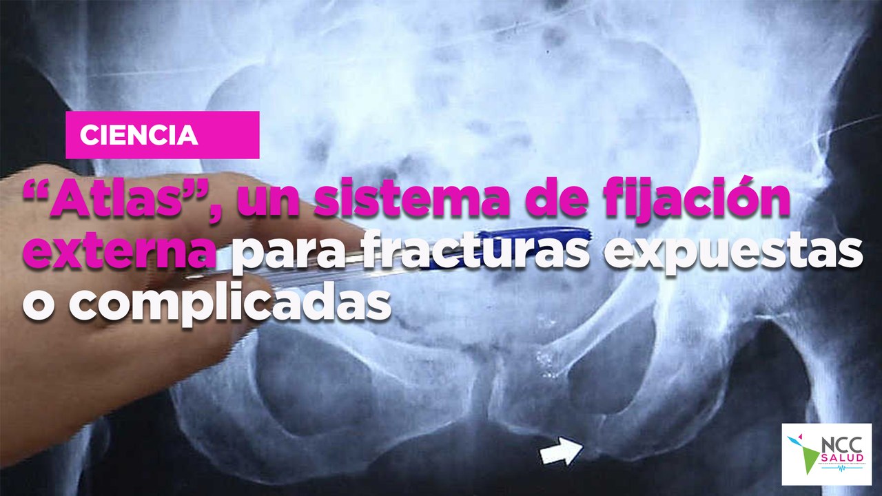 “Atlas”, un sis­te­ma de fi­ja­ción ex­ter­na para frac­tu­ras ex­pues­tas o com­pli­ca­das