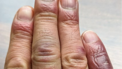 Plötzlich blaue Finger: Das steckt (meist) dahinter