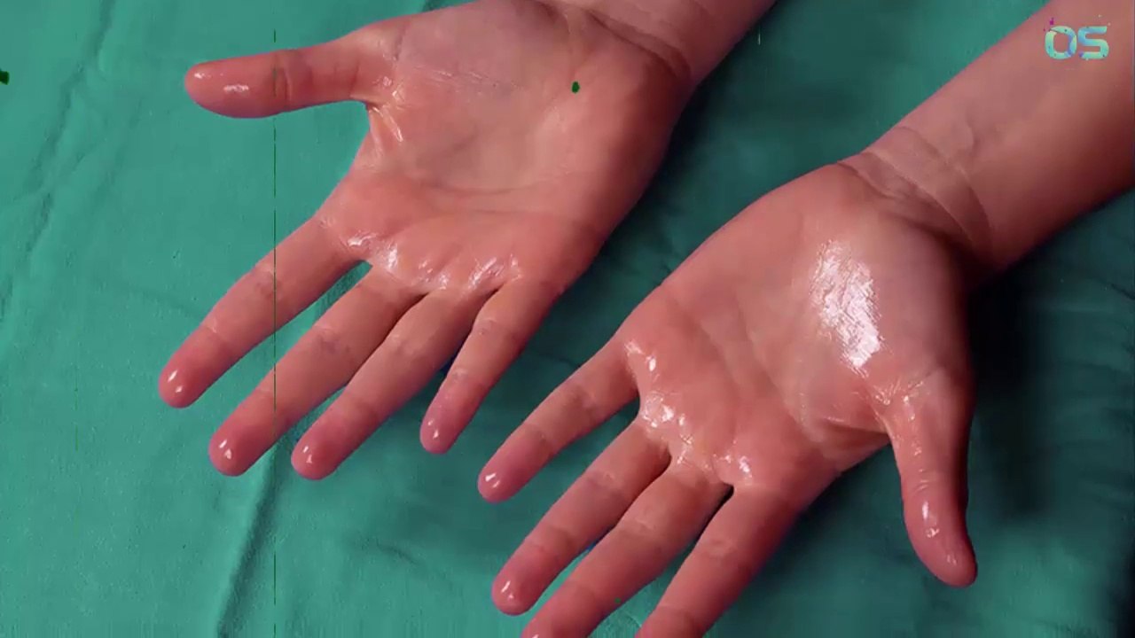 How to Stop Excessive Sweaty Palms and Sweaty Hands