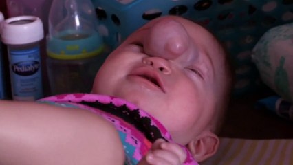 Watch This Baby's Life Changing Brain Surgery