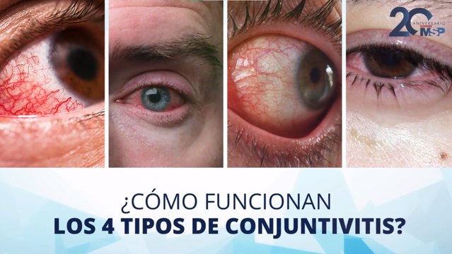 ¿Qué es la conjuntivitis y cuáles son sus cuatro tipos? - #ExclusivoMSP