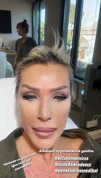 Seda Sayan suratına sünnet derisinden sıvı enjekte ettirdi