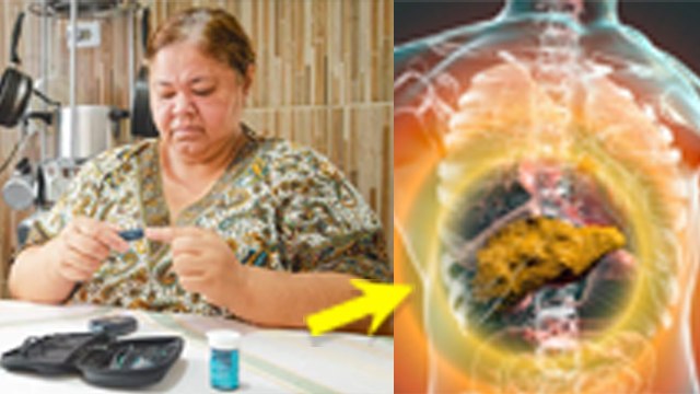 डायबिटीज के मरीजों को लिवर फाइब्रोसिस क्यों होता है |Diabetes Liver Fibrosis Symptoms And Causes