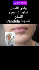 علاج بياض او فطريات اللسان و الفم