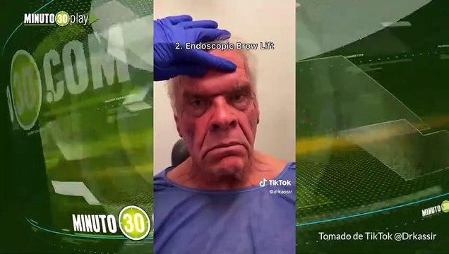 Hombre se hizo cirugía estética para verse más joven y ahora es otro