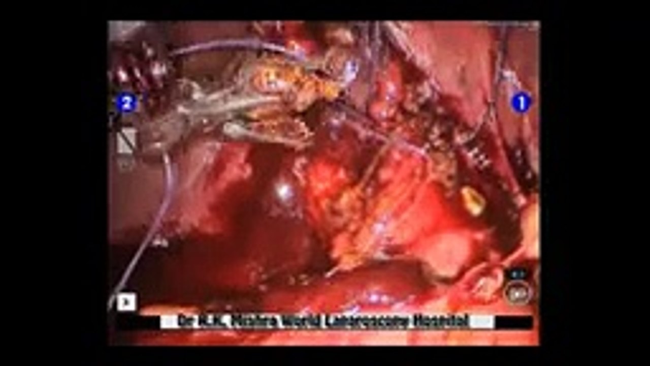 da Vinci Robotic Cholecystectomy for Mirizzi's syndrome by Dr R K Mishra