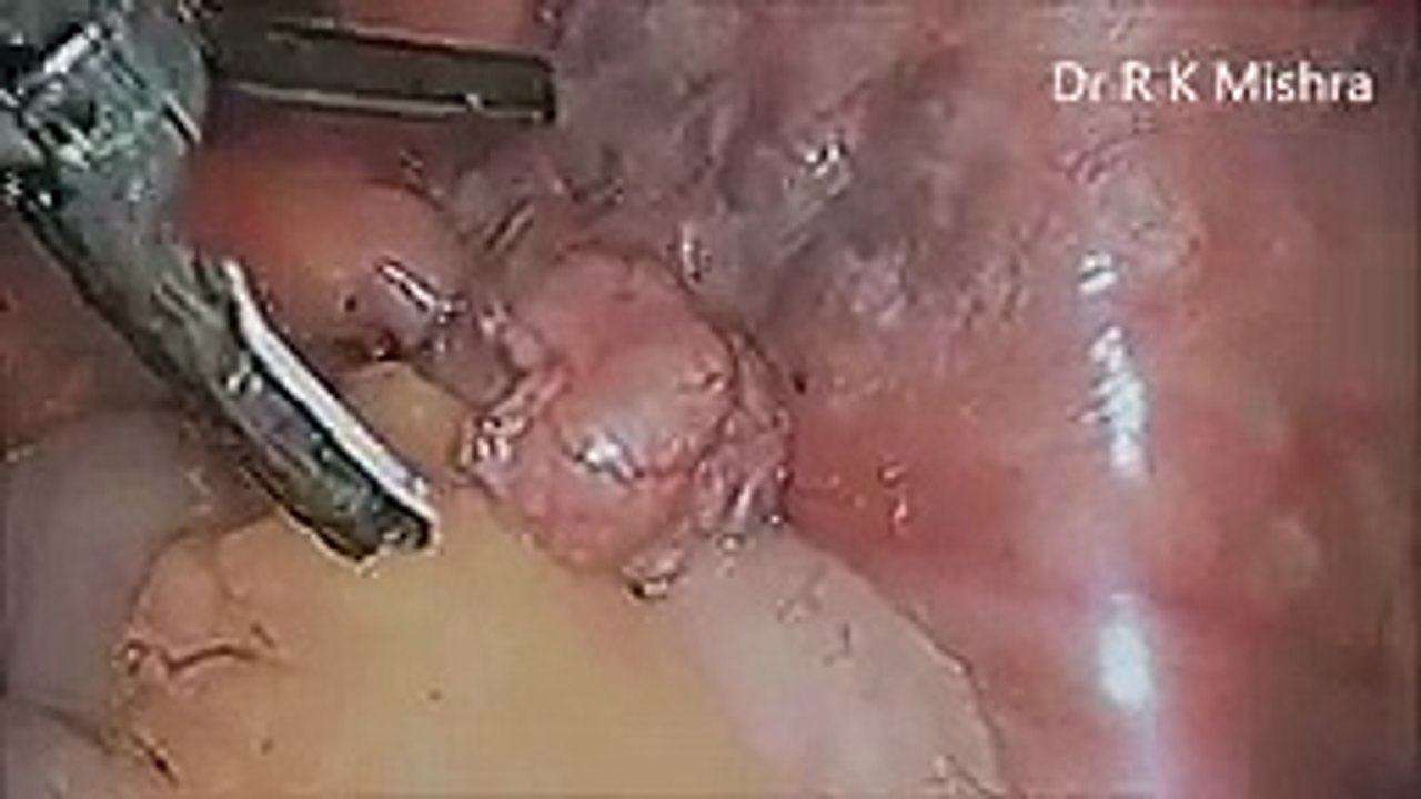 Dr R K Mishra demonstrating Laparoscopic Sterilization with Harminic Scalpel