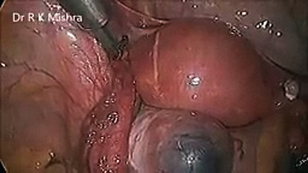 Dr. R.K. Mishra demonstrating Female Laparoscopic Sterilization by Harmonic Scalpel